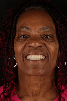 Confident patient smile post smile rehabilitation with dental implants and crowns.
